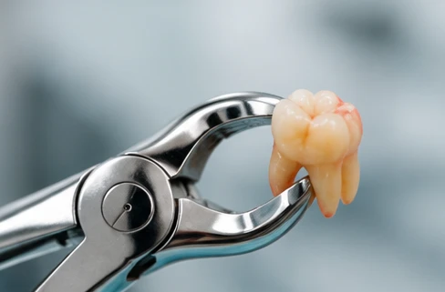 Molar extras cu clește chirurgical – extracție dentară Clinica Rodenta