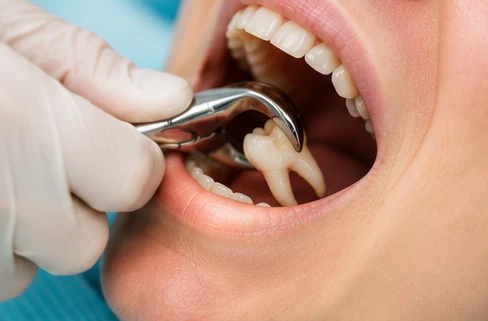 Extracție dentară în cabinet stomatologic premium Sector 2